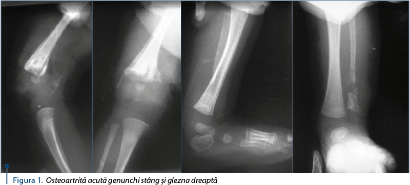 Figura 1. Osteoartrită acută genunchi stâng şi glezna dreaptă
