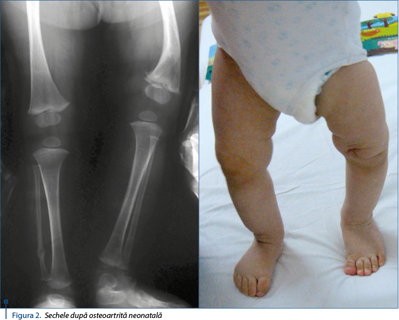 Figura 2. Sechele după osteoartrită neonatală