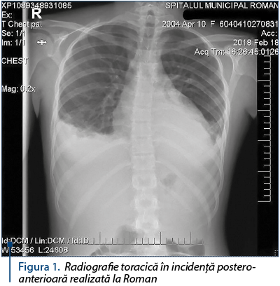 Figura 1. Radiografie toracică în incidenţă postero-anterioară realizată la Roman 