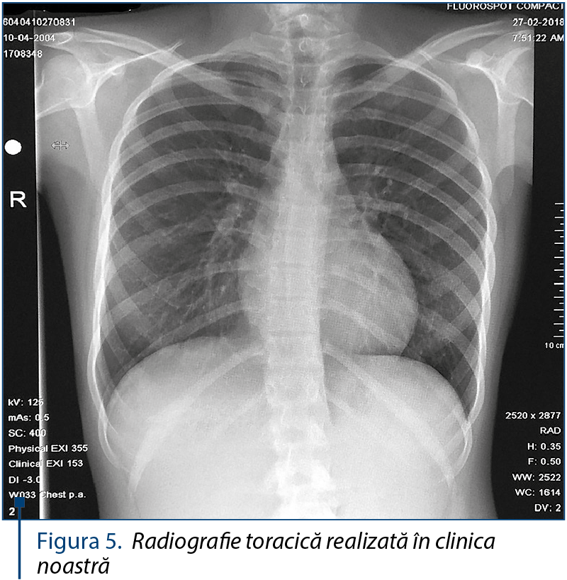 Figura 5. Radiografie toracică realizată în clinica noastră 