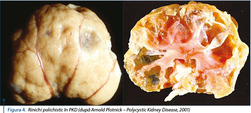 Figura 4. Rinichi polichistic în PKD (după Arnold Plotnick – Polycystic Kidney Disease, 2001)