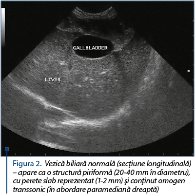 Figura 2. Vezică biliară normală (secţiune lon­gi­tu­di­na­lă) – apare ca o structură piriformă (20-40 mm în diametru), cu perete slab reprezentat (1-2 mm) şi con­ţinut omogen transsonic (în abordare paramediană dreap­tă)