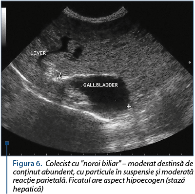 Figura 6. Colecist cu "noroi biliar" – moderat destinsă de conţinut abundent, cu particule în suspensie şi moderată reacţie parietală. Ficatul are aspect hipoecogen (stază hepatică)