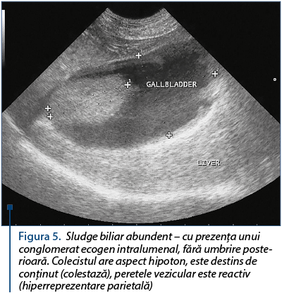 Figura 5. Sludge biliar abundent – cu prezenţa unui conglomerat ecogen intralumenal, fără umbrire poste­rioa­ră. Colecistul are aspect hipoton, este destins de con­ţinut (colestază), peretele vezicular este reactiv (hiperreprezentare parietală)