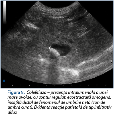 Figura 8. Colelitiază – prezenţa intralumenală a unei mase ovoide, cu contur regulat, ecostructură omogenă, însoţită distal de fenomenul de umbrire netă (con de umbră curat). Evidentă reacţie parietală de tip infiltrativ difuz