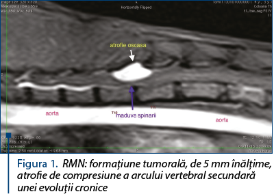 Figura 1. RMN: formaţiune tumorală, de 5 mm înălţime, atrofie de compresiune a arcului vertebral secundară unei evoluţii cronice
