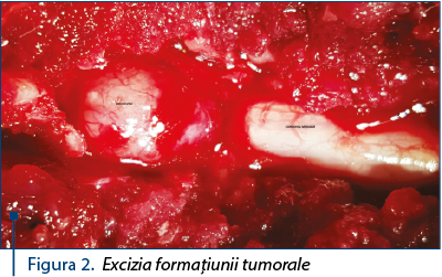 Figura 2. Excizia formaţiunii tumorale