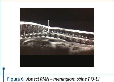 Figura 6. Aspect RMN – meningiom câine T13-L1