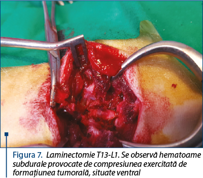 Figura 7. Laminectomie T13-L1. Se observă hematoame subdurale provocate de compresiunea exercitată de formaţiunea tumorală, situate ventral