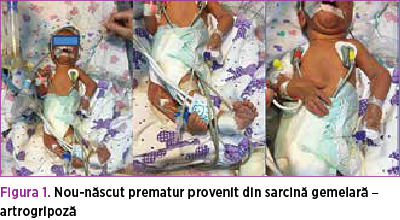 Figura 1. Nou-născut prematur provenit din sarcină gemelară – artrogripoză