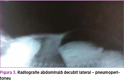 Figura 3. Radiografie abdominală decubit lateral – pneumoperitoneu