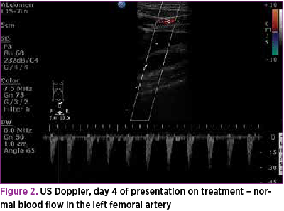Figure 2. US Doppler, day 4 of presentation on treatment – normal blood flow in the left femoral artery