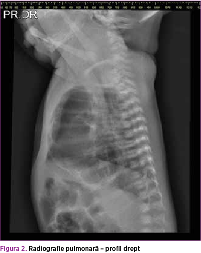 Figura 2. Radiografie pulmonară – profil drept