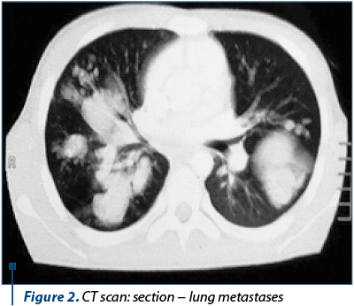Figure 2. CT scan: section − lung metastases 