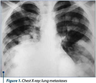 Figure 1. Chest X-ray: lung metastases 