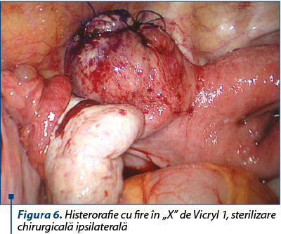 Figura 6. Histerorafie cu fire în „X” de Vicryl 1, sterilizare chirurgicală ipsilaterală