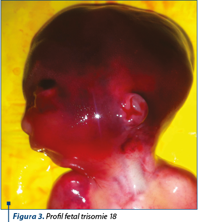 Figura 3. Profil fetal trisomie 18