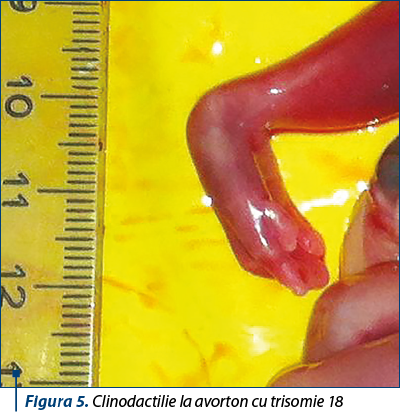 Figura 5. Clinodactilie la avorton cu trisomie 18