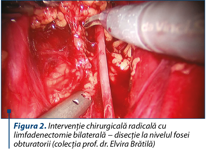 Figura 2. Intervenţie chirurgicală radicală cu limfadenectomie bilaterală − disecţie la nivelul fose