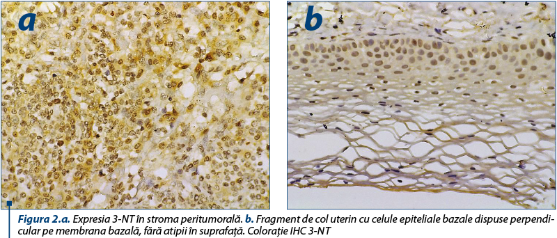 Figura 2.a. Expresia 3-NT în stroma peritumorală. b. Fragment de col uterin cu celule epiteliale bazale dispuse per­pen­di­cu­lar pe membrana bazală, fără atipii în suprafaţă. Coloraţie IHC 3-NT