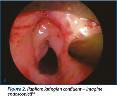 Figura 2. Papilom laringian confluent − imagine endoscopică(7)