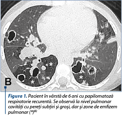 Figura 1. Pacient în vârstă de 6 ani cu papilomatoză respiratorie recurentă. Se observă la nivel pulmonar cavităţi cu pereţi subţiri şi groşi, dar şi zone de emfizem pulmonar (*)(6)