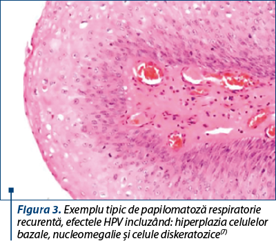 Figura 3. Exemplu tipic de papilomatoză respiratorie recurentă, efectele HPV incluzând: hiperplazia celulelor bazale, nucleomegalie şi celule diskeratozice(7)