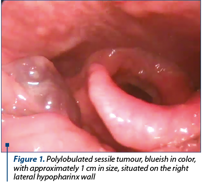 Figure 1. Polylobulated sessile tumour, blueish in color, with approximately 1 cm in size, situated on the right lateral hypopharinx wall
