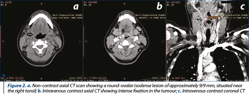 Figure 2. a. Non-contrast axial CT scan showing a round-ovalar isodense lesion of approximately 9/9 mm, situated near the right tonsil; b. Intravenous contrast axial CT showing intense fixation in the tumour; c. Intravenous contrast coronal CT