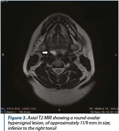 Figure 3. Axial T2 MRI showing a round-ovalar hypersignal lesion, of approximately 11/9 mm in size, inferior to the right tonsil