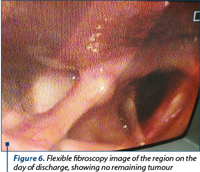 Figure 6. Flexible fibroscopy image of the region on the day of discharge, showing no remaining tumour