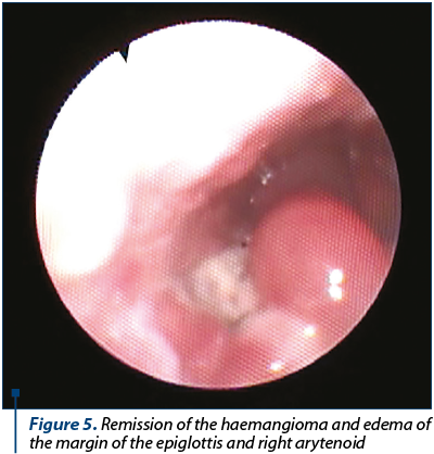 Figure 5. Remission of the haemangioma and edema of the margin of the epiglottis and right arytenoid
