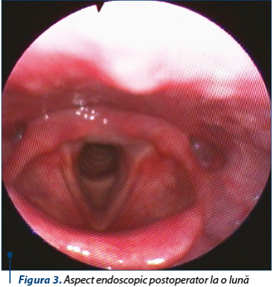 Figura 3. Aspect endoscopic postoperator la o lună