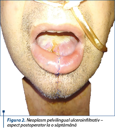 Figura 2. Neoplasm pelvilingual ulceroinfiltrativ – aspect postoperator la o săptămână
