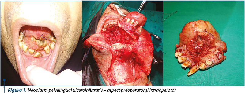 Figura 1. Neoplasm pelvilingual ulceroinfiltrativ – aspect preoperator şi intraoperator