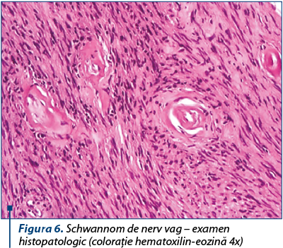 Figura 6. Schwannom de nerv vag – examen histopatologic (coloraţie hematoxilin-eozină 4x)