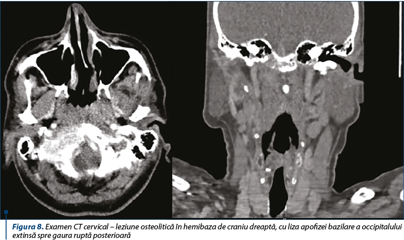 Figura 8. Examen CT cervical – leziune osteolitică în hemibaza de craniu dreaptă, cu liza apofizei bazilare a occipitalului extinsă spre gaura ruptă posterioară