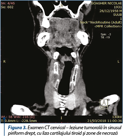 Figura 3. Examen CT cervical – leziune tumorală în sinusul piriform drept, cu liza cartilajului tiroid şi zone de necroză