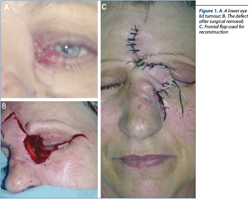Figure 1. A. A lower eye lid tumour; B. The defect after surgical removal; C. Frontal flap used for reconstruction
