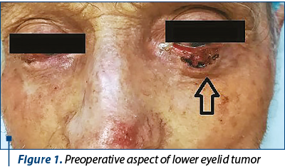 Figure 1. Preoperative aspect of lower eyelid tumor