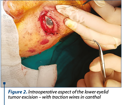 Figure 2. Intraoperative aspect of the lower eyelid tumor excision – with traction wires in canthal 