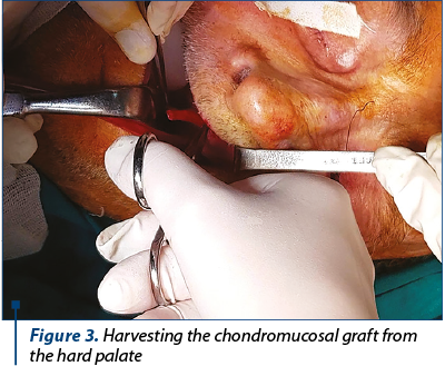 Figure 3. Harvesting the chondromucosal graft from the hard palate