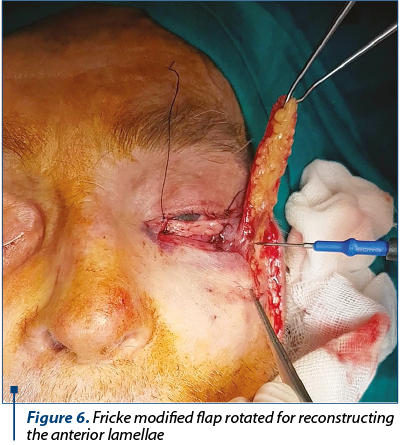 Figure 6. Fricke modified flap rotated for reconstructing the anterior lamellae