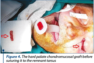 Figure 4. The hard palate chondromucosal graft before suturing it to the remnant tarsus
