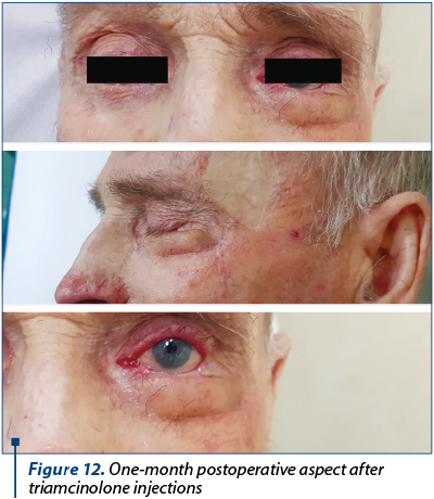 Figure 12. One-month postoperative aspect after triamcinolone injections