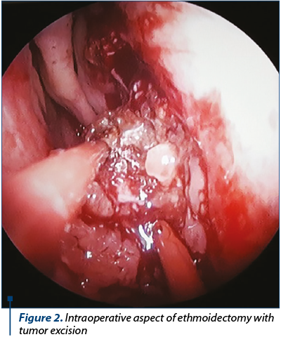 Figure 2. Intraoperative aspect of ethmoidectomy with tumor excision