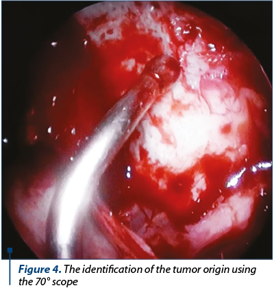 Figure 4. The identification of the tumor origin using the 70° scope
