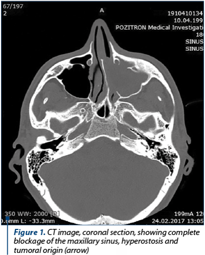 Figure 1. CT image, coronal section, showing complete blockage of the maxillary sinus, hyperostosis and tumoral origin (arrow)