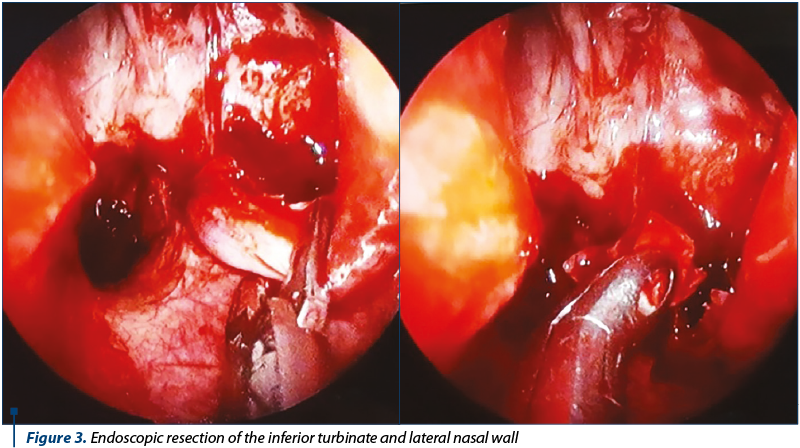 Figure 3. Endoscopic resection of the inferior turbinate and lateral nasal wall