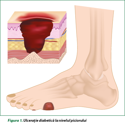 Figura 1. Ulceraţie diabetică la nivelul piciorului